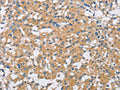 The image on the left is immunohistochemistry of paraffin-embedded Human thyroid cancer tissue using CSB-PA106166(SH3GLB1 Antibody) at dilution 1/25, on the right is treated with fusion protein. (Original magnification: ×200)