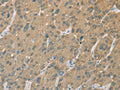 The image on the left is immunohistochemistry of paraffin-embedded Human liver cancer tissue using CSB-PA106326(CYP2C9 Antibody) at dilution 1/50, on the right is treated with fusion protein. (Original magnification: ×200)