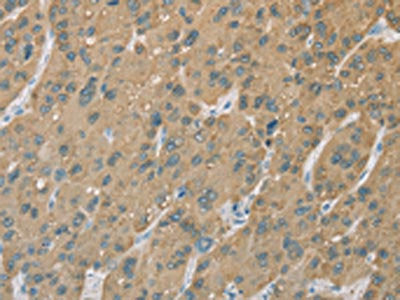 The image on the left is immunohistochemistry of paraffin-embedded Human liver cancer tissue using CSB-PA106326(CYP2C9 Antibody) at dilution 1/50, on the right is treated with fusion protein. (Original magnification: ×200)