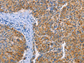 The image on the left is immunohistochemistry of paraffin-embedded Human liver cancer tissue using CSB-PA106672(FGL1 Antibody) at dilution 1/25, on the right is treated with fusion protein. (Original magnification: ×200)