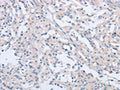 The image on the left is immunohistochemistry of paraffin-embedded Human thyroid cancer tissue using CSB-PA106715(AGAP2 Antibody) at dilution 1/60, on the right is treated with synthetic peptide. (Original magnification: ×200)