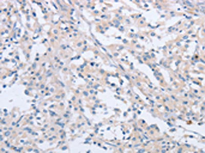 The image on the left is immunohistochemistry of paraffin-embedded Human thyroid cancer tissue using CSB-PA106715(AGAP2 Antibody) at dilution 1/60, on the right is treated with synthetic peptide. (Original magnification: ×200)