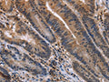 The image on the left is immunohistochemistry of paraffin-embedded Human colon cancer tissue using CSB-PA106926(ETV7 Antibody) at dilution 1/30, on the right is treated with fusion protein. (Original magnification: ×200)