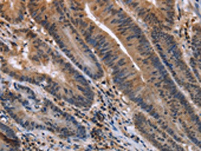 The image on the left is immunohistochemistry of paraffin-embedded Human colon cancer tissue using CSB-PA106926(ETV7 Antibody) at dilution 1/30, on the right is treated with fusion protein. (Original magnification: ×200)