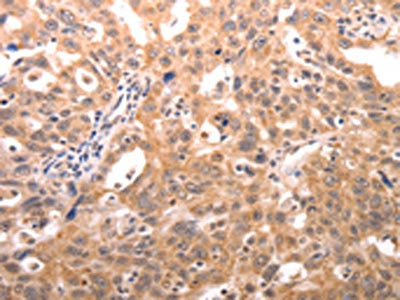 The image on the left is immunohistochemistry of paraffin-embedded Human ovarian cancer tissue using CSB-PA106939(SERPINC1 Antibody) at dilution 1/30, on the right is treated with fusion protein. (Original magnification: ×200)
