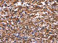 The image on the left is immunohistochemistry of paraffin-embedded Human thyroid cancer tissue using CSB-PA107052(IL1A Antibody) at dilution 1/40, on the right is treated with fusion protein. (Original magnification: ×200)