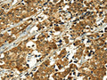 The image on the left is immunohistochemistry of paraffin-embedded Human breast cancer tissue using CSB-PA107181(MAPKAPK5 Antibody) at dilution 1/35, on the right is treated with fusion protein. (Original magnification: ×200)