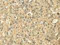 The image on the left is immunohistochemistry of paraffin-embedded Human breast cancer tissue using CSB-PA107310(SDHA Antibody) at dilution 1/40, on the right is treated with fusion protein. (Original magnification: ×200)