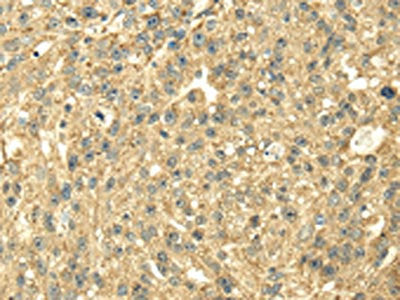 The image on the left is immunohistochemistry of paraffin-embedded Human breast cancer tissue using CSB-PA107310(SDHA Antibody) at dilution 1/40, on the right is treated with fusion protein. (Original magnification: ×200)