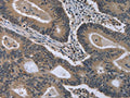 The image on the left is immunohistochemistry of paraffin-embedded Human colon cancer tissue using CSB-PA107336(MCM3AP Antibody) at dilution 1/30, on the right is treated with fusion protein. (Original magnification: ×200)