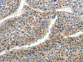 The image on the left is immunohistochemistry of paraffin-embedded Human liver cancer tissue using CSB-PA107614(HTR3A Antibody) at dilution 1/35, on the right is treated with fusion protein. (Original magnification: ×200)