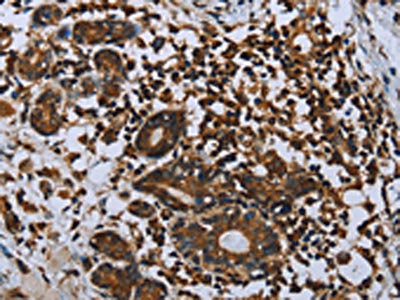 The image on the left is immunohistochemistry of paraffin-embedded Human breast cancer tissue using CSB-PA107902(IL31RA Antibody) at dilution 1/20, on the right is treated with fusion protein. (Original magnification: ×200)