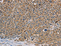 The image on the left is immunohistochemistry of paraffin-embedded Human ovarian cancer tissue using CSB-PA107998(NDUFS7 Antibody) at dilution 1/40, on the right is treated with fusion protein. (Original magnification: ×200)