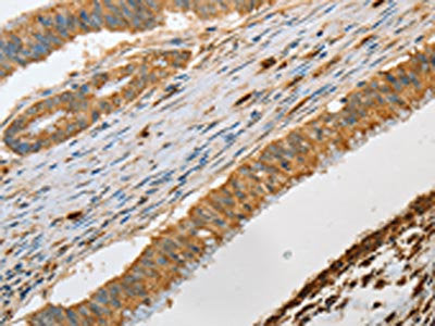 The image on the left is immunohistochemistry of paraffin-embedded Human colon cancer tissue using CSB-PA108047(GZMB Antibody) at dilution 1/30, on the right is treated with fusion protein. (Original magnification: ×200)