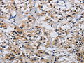 The image on the left is immunohistochemistry of paraffin-embedded Human thyroid cancer tissue using CSB-PA108283(ITGA11 Antibody) at dilution 1/20, on the right is treated with synthetic peptide. (Original magnification: ×200)