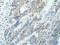 The image on the left is immunohistochemistry of paraffin-embedded Human colon cancer tissue using CSB-PA108298(RNF126 Antibody) at dilution 1/70, on the right is treated with synthetic peptide. (Original magnification: ×200)