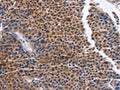 The image on the left is immunohistochemistry of paraffin-embedded Human liver cancer tissue using CSB-PA108299(MAP3K13 Antibody) at dilution 1/20, on the right is treated with fusion protein. (Original magnification: ×200)