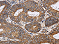 The image on the left is immunohistochemistry of paraffin-embedded Human colon cancer tissue using CSB-PA108491(PDGFC Antibody) at dilution 1/40, on the right is treated with synthetic peptide. (Original magnification: ×200)