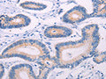 The image on the left is immunohistochemistry of paraffin-embedded Human colon cancer tissue using CSB-PA108827(TEKT4 Antibody) at dilution 1/20, on the right is treated with fusion protein. (Original magnification: ×200)