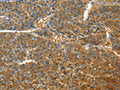 The image on the left is immunohistochemistry of paraffin-embedded Human liver cancer tissue using CSB-PA108957(TNFSF13B Antibody) at dilution 1/30, on the right is treated with fusion protein. (Original magnification: ×200)