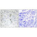 Immunohistochemistry analysis of paraffin-embedded human breast carcinoma tissue, using BATF antibody.