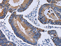 The image on the left is immunohistochemistry of paraffin-embedded Human colon cancer tissue using CSB-PA109564(CA4 Antibody) at dilution 1/30, on the right is treated with fusion protein. (Original magnification: ×200)