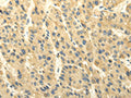 The image on the left is immunohistochemistry of paraffin-embedded Human liver cancer tissue using CSB-PA109776(ABCB7 Antibody) at dilution 1/20, on the right is treated with fusion protein. (Original magnification: ×200)