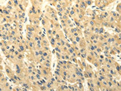 The image on the left is immunohistochemistry of paraffin-embedded Human liver cancer tissue using CSB-PA109776(ABCB7 Antibody) at dilution 1/20, on the right is treated with fusion protein. (Original magnification: ×200)