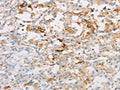 The image on the left is immunohistochemistry of paraffin-embedded Human thyroid cancer tissue using CSB-PA110084(OLFM1 Antibody) at dilution 1/30, on the right is treated with fusion protein. (Original magnification: ×200)