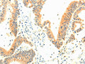 The image on the left is immunohistochemistry of paraffin-embedded Human colon cancer tissue using CSB-PA110310(TERF1 Antibody) at dilution 1/30, on the right is treated with fusion protein. (Original magnification: ×200)