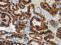 The image on the left is immunohistochemistry of paraffin-embedded Human thyroid cancer tissue using CSB-PA110327(ASB4 Antibody) at dilution 1/40, on the right is treated with fusion protein. (Original magnification: ×200)