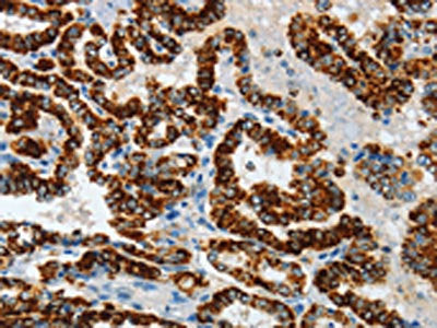 The image on the left is immunohistochemistry of paraffin-embedded Human thyroid cancer tissue using CSB-PA110327(ASB4 Antibody) at dilution 1/40, on the right is treated with fusion protein. (Original magnification: ×200)
