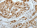 The image on the left is immunohistochemistry of paraffin-embedded Human lung cancer tissue using CSB-PA110553(MCM3 Antibody) at dilution 1/25, on the right is treated with fusion protein. (Original magnification: ×200)