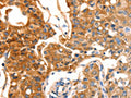 The image on the left is immunohistochemistry of paraffin-embedded Human lung cancer tissue using CSB-PA110757(MVP Antibody) at dilution 1/30, on the right is treated with fusion protein. (Original magnification: ×200)