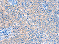 The image on the left is immunohistochemistry of paraffin-embedded Human cervical cancer tissue using CSB-PA110823(ACOX1 Antibody) at dilution 1/20, on the right is treated with fusion protein. (Original magnification: ×200)
