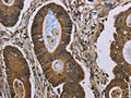The image on the left is immunohistochemistry of paraffin-embedded Human colon cancer tissue using CSB-PA111065(NEFH Antibody) at dilution 1/40, on the right is treated with synthetic peptide. (Original magnification: ×200)