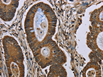 The image on the left is immunohistochemistry of paraffin-embedded Human colon cancer tissue using CSB-PA111065(NEFH Antibody) at dilution 1/40, on the right is treated with synthetic peptide. (Original magnification: ×200)