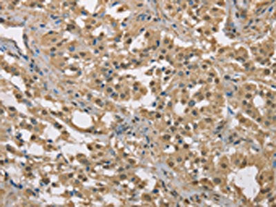 The image on the left is immunohistochemistry of paraffin-embedded Human thyroid cancer tissue using CSB-PA111089(DACH2 Antibody) at dilution 1/40, on the right is treated with fusion protein. (Original magnification: ×200)