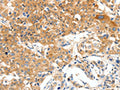 The image on the left is immunohistochemistry of paraffin-embedded Human lung cancer tissue using CSB-PA111403(PLAT Antibody) at dilution 1/50, on the right is treated with synthetic peptide. (Original magnification: ×200)