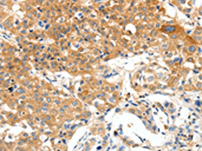 The image on the left is immunohistochemistry of paraffin-embedded Human lung cancer tissue using CSB-PA111403(PLAT Antibody) at dilution 1/50, on the right is treated with synthetic peptide. (Original magnification: ×200)