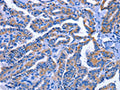 The image on the left is immunohistochemistry of paraffin-embedded Human thyroid cancer tissue using CSB-PA111413(IGSF10 Antibody) at dilution 1/60, on the right is treated with fusion protein. (Original magnification: ×200)