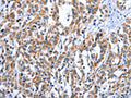 The image on the left is immunohistochemistry of paraffin-embedded Human esophagus cancer tissue using CSB-PA111567(EDN3 Antibody) at dilution 1/30, on the right is treated with fusion protein. (Original magnification: ×200)