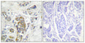 Immunohistochemical analysis of paraffin-embedded human breast carcinoma tissue, using ITGB4 (Phospho-Tyr1510) antibody (left)or the same antibody preincubated with blocking peptide (right).