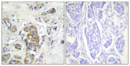 Immunohistochemical analysis of paraffin-embedded human breast carcinoma tissue, using ITGB4 (Phospho-Tyr1510) antibody (left)or the same antibody preincubated with blocking peptide (right).