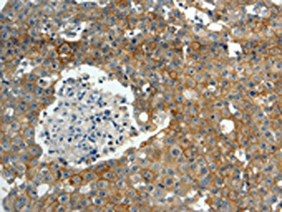 The image on the left is immunohistochemistry of paraffin-embedded Human breast cancer tissue using CSB-PA112004(ABCC10 Antibody) at dilution 1/30, on the right is treated with synthetic peptide. (Original magnification: ×200)