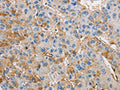 The image on the left is immunohistochemistry of paraffin-embedded Human liver cancer tissue using CSB-PA112219(DIRAS3 Antibody) at dilution 1/25, on the right is treated with fusion protein. (Original magnification: ×200)