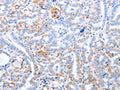 The image on the left is immunohistochemistry of paraffin-embedded Human thyroid cancer tissue using CSB-PA112350(TRAF3IP3 Antibody) at dilution 1/25, on the right is treated with fusion protein. (Original magnification: ×200)