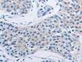 The image on the left is immunohistochemistry of paraffin-embedded Human lung cancer tissue using CSB-PA112444(HOXA6 Antibody) at dilution 1/60, on the right is treated with fusion protein. (Original magnification: ×200)