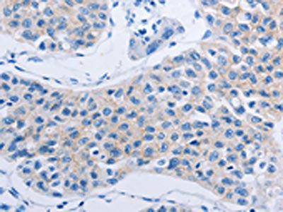The image on the left is immunohistochemistry of paraffin-embedded Human lung cancer tissue using CSB-PA112444(HOXA6 Antibody) at dilution 1/60, on the right is treated with fusion protein. (Original magnification: ×200)