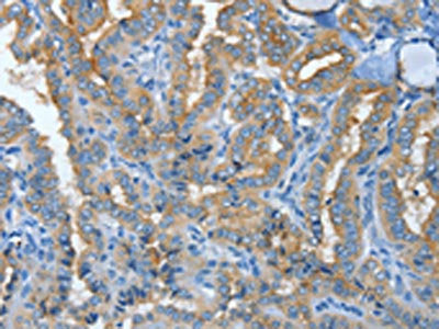 The image on the left is immunohistochemistry of paraffin-embedded Human thyroid cancer tissue using CSB-PA113113(MUC15 Antibody) at dilution 1/50, on the right is treated with fusion protein. (Original magnification: ×200)